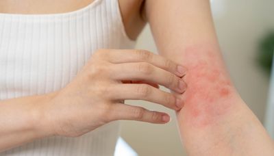 皮膚起紅疹，會自己好嗎？起紅疹8大原因、5種改善方法完整解析