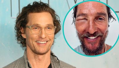 Matthew McConaughey's Eye Swells Shut In Startling Bee Sting Photo | Access