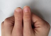 Brachydactyly type D