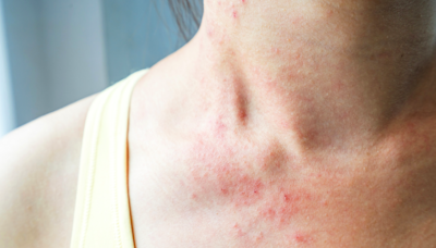 These Pictures Will Help You Identify the Most Common Skin Rashes