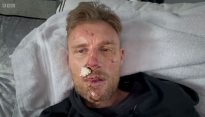 Freddie Flintoff reveals full facial injuries in tearful home video after Top Gear crash