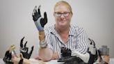 Titanium-fused bone tissue connects this bionic hand directly to a patient's nerves