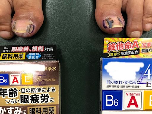 眼藥水改善甲溝炎！關鍵成分是它 維他命B眼藥水、青光眼藥水都有效