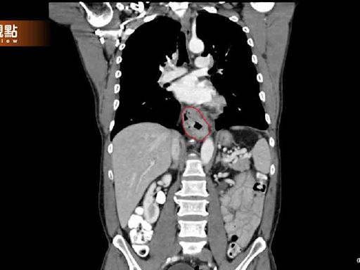 6旬婦半年狂掉8公斤！一查竟「食道癌末期」