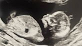My Husband And I Are Trying To Start A Family. Six Months Ago, I Had An Abortion.