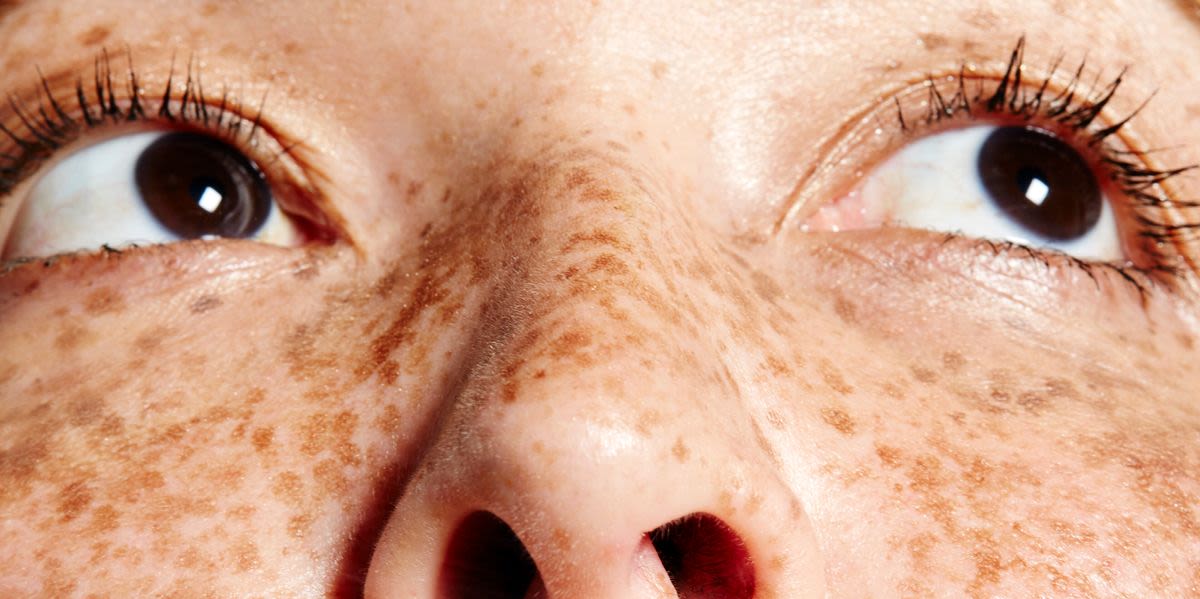 Freckles Are 'In' Now — And People Who Grew Up Hating Theirs Have Thoughts