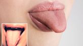 Shock time-lapse video reveals tiny 'white spot' on tongue morphing into cancer