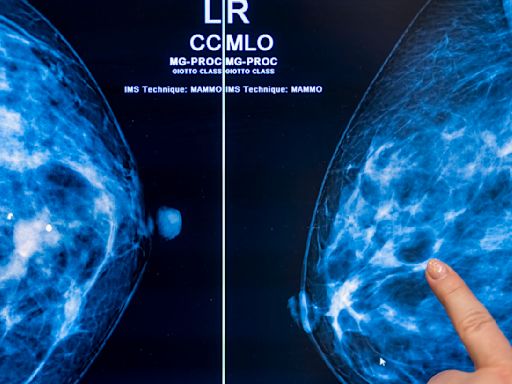 Breast density and mammograms: New FDA rule will ensure all women have more information after cancer screenings