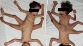 One in two million ‘spider twins’ have 3 legs, 4 arms and 1 penis