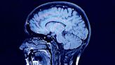 Experimental drug shown to 'significantly' slow progression of brain cancer