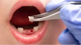 Emergency Dentist Perth Announces Emergency Tooth Extraction Services
