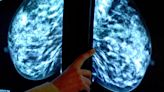 Older women’s breast cancer is often overdiagnosed, study finds, raising risk of unnecessary treatment