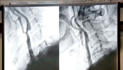 頸動脈狹窄中風裝支架 術後戒菸控血壓 - 自由健康網