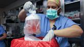 Pig kidney transplanted into human patient for 1st time ever