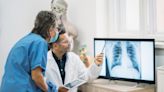 Lung cancer screening guidelines updated, NY study finds screenings increase 'cure rate'