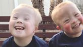 Everything you need to know about Down syndrome