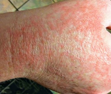 COVID Rash: Explaining Short- and Long-Term Symptoms