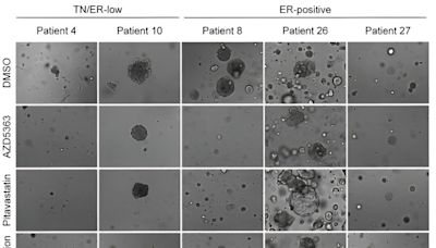 Combining cholesterol-lowering statins with existing cancer drug shows potent effect against breast cancer subtype