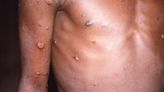 1st monkeypox case reported in Beaver County