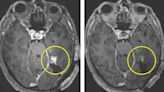 A new strategy to attack aggressive brain cancer shrank tumours in two early tests