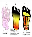 Plantar fasciitis