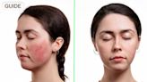 How to manage rosacea: from common triggers to the best treatments