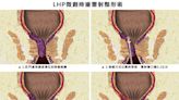 吃抗凝血藥痔瘡更嚴重血流不止 雷射整形手術20分鐘解決困擾