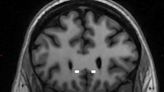 Neuralink’s first human brain implant malfunctions