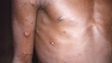 San Francisco reports first suspected monkeypox case