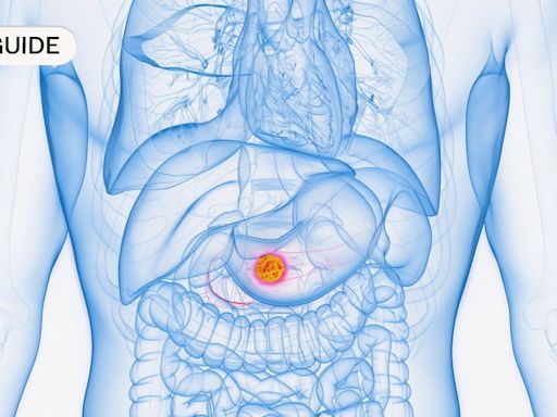 Pancreatic cancer: Symptoms, causes and treatment