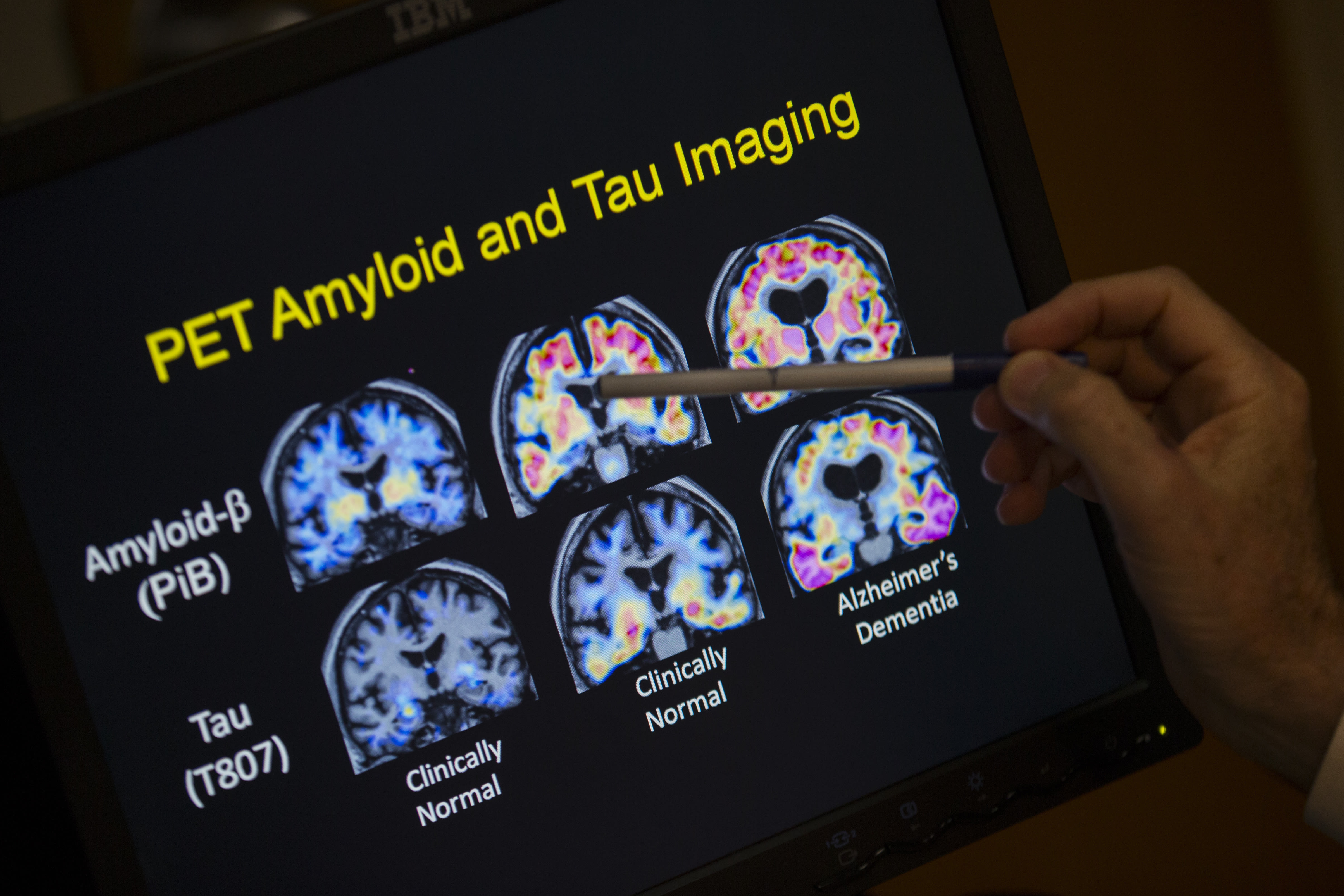 Blood tests for Alzheimer's may be coming to your doctor's office. Here's what to know