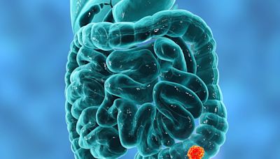 Researchers developing new colon cancer tests amid rising cases