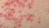 名醫會客室／疱疹性濕疹-嚴重異位性皮膚炎的併發症