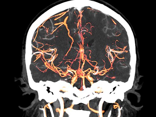 The Starting Point of Schizophrenia May Have Been Found in Brain Scans