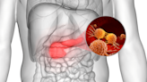 作家小彤胰臟頭出現2.3公分惡性腫廇！為什麼「胰頭」手術比「胰尾」複雜？