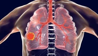 Cáncer de pulmón no microcítico en ascenso: un 16% más en 5 años