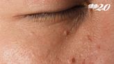 45歲女「臉上凸一顆」嚇壞還會長大！醫：這種皮膚病會傳染 3招可預防