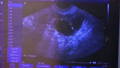 Iowa Supreme Court rules fetal heartbeat law constitutional