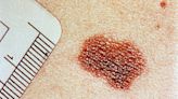 La falta de atención al melanoma en la pandemia causó perdidas de 7.100 millones de euros
