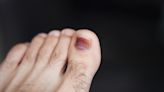 「凍甲」痛到走路有困難 樂生醫：這樣剪指甲可預防