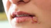 嘴角裂、紅腫...是「唇皰疹or嘴角炎」？專家揭兩者差異 小心餐具、毛巾會傳染
