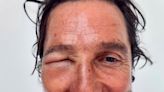 Matthew McConaughey sufre una picadura de abeja que le dejó la cara completamente hinchada