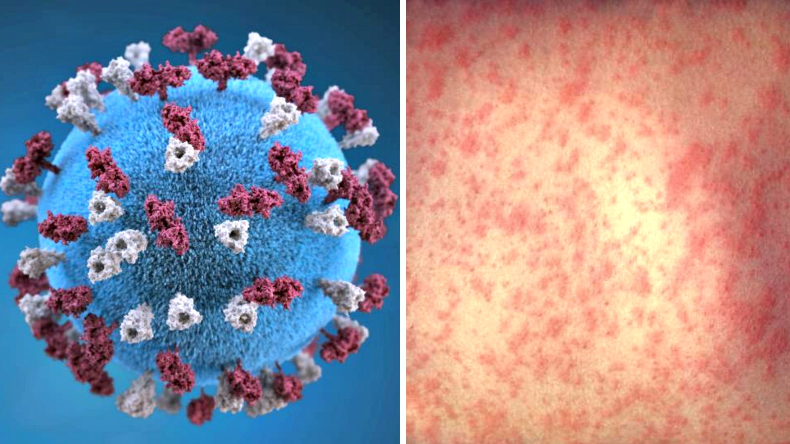 Measles case confirmed in New Orleans, Louisiana Department of Health reports