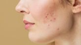 Is your acne treatment safe? Cancer-causing chemical found in Proactiv, Clearasil and more