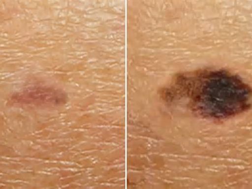 Alarming time-lapse video reveals how tiny ‘dark patch’ morphs into melanoma