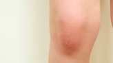 The Real Reason Your Knee Is Swollen, According to Doctors