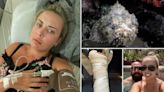 Honeymoon bride stung by one of world's most venomous fish