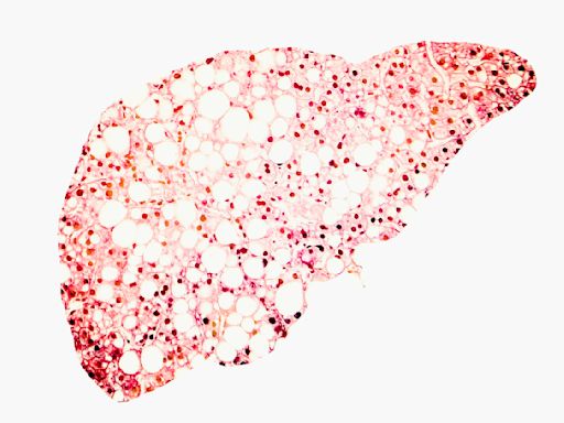 Diabetes and obesity can damage the liver to the point of failure – but few people know their risk of developing liver disease