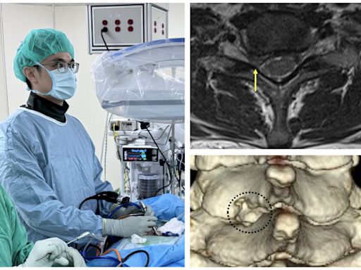 肩頸手臂痠痛麻 新竹臺大分院用頸椎內視鏡切除術 - 自由健康網