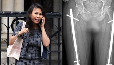 Banker suing for £1,000,000 after op left her with one leg longer than the other